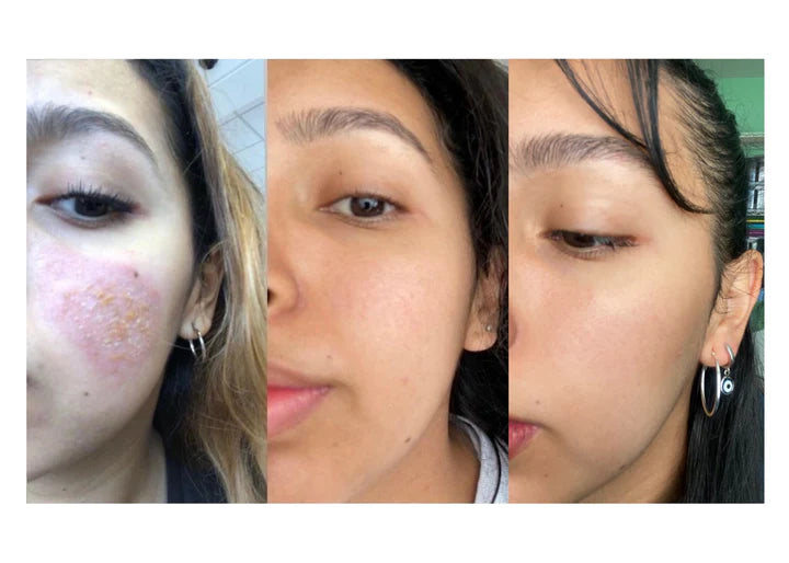 uncle benneys soaps that heal oilblends, Helping people fix their skin problem is our passion,facial hyperpigmntation treatment, dark marks and spots treatment, best skin problem treatment, turmeric toner