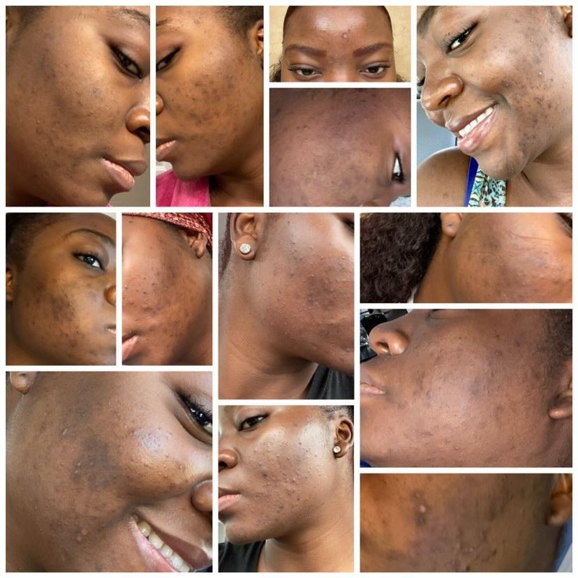 how to naturally fade dark spots on black skin, oilblends products, uncle benney's plant based skincare products for black people