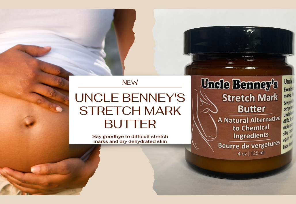 Jojoba oil,Coconut oil,Shea butter,Uncle Benney's Stretch mark pregnancy body butter,how to remove difficult  stretchmarks