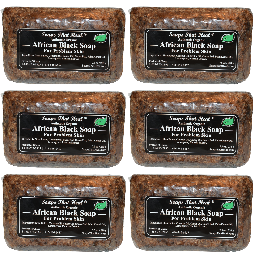 soaps that heal african black soap ,products of ghana, shea butter, plantain extract ,hyperpigmentation deep cleansing plantain extract,african black soap to remove dark marks, black soap for hyperpigmentation,african black soap benefits,how to use african black soap,raw black soap,black soap for face,acne afrian black soap,Facial Acanthosis Nigricans,asymptomatic, velvety, clear facial hyperpigmentation, remove dark marks and spots, castor oil, healthy skin treatment, clean products,