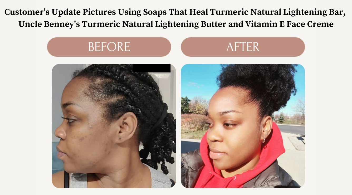 Customer’s before and after Update Pictures Using OilBlends products, Soaps That Heal Turmeric Natural Lightening Bar,  Uncle Benney's Turmeric Natural Lightening Butter and Vitamin E Face Creme to get rid of dark marks