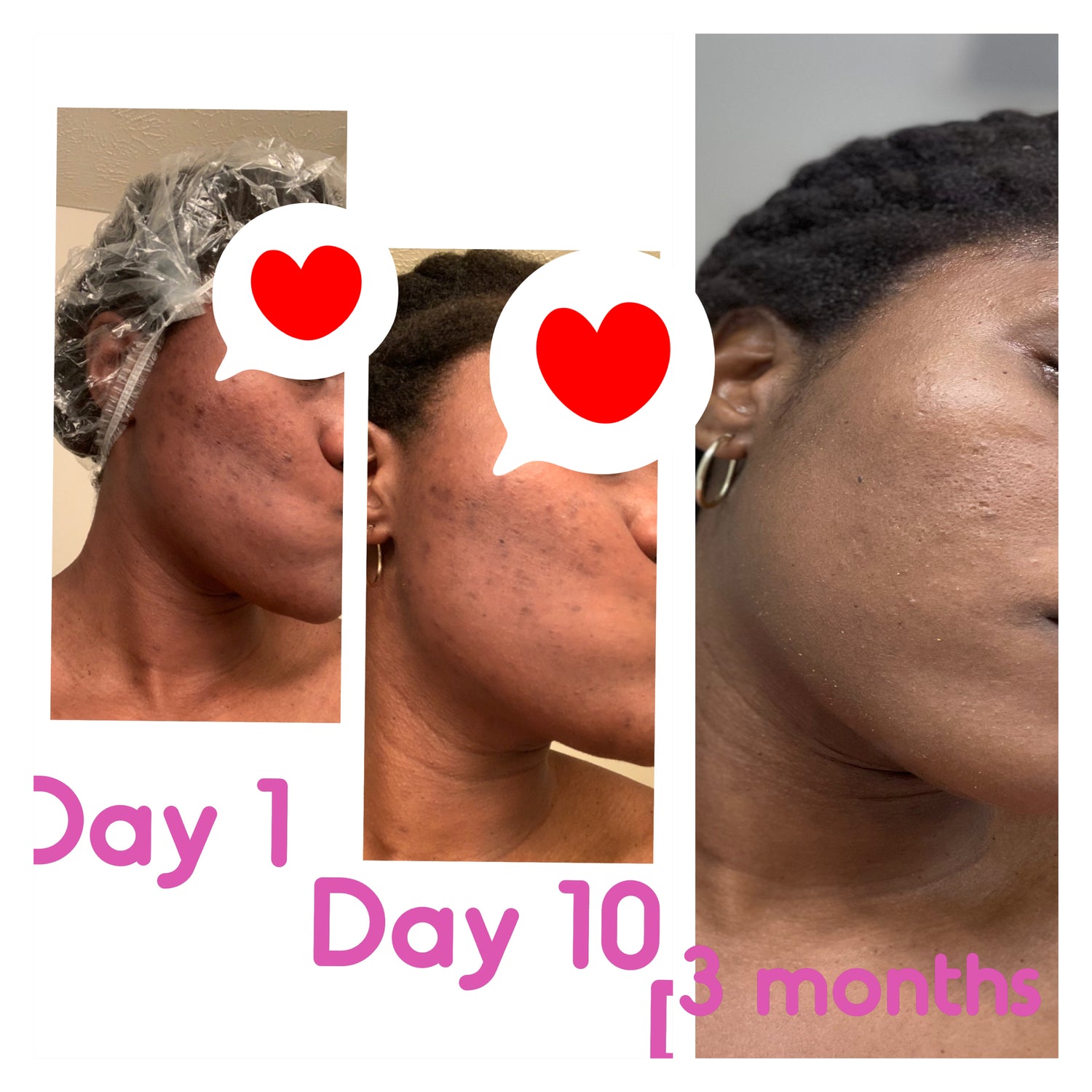 uncle benney's plant based skincare routine results for clearing hyperpigmentation and dark marks