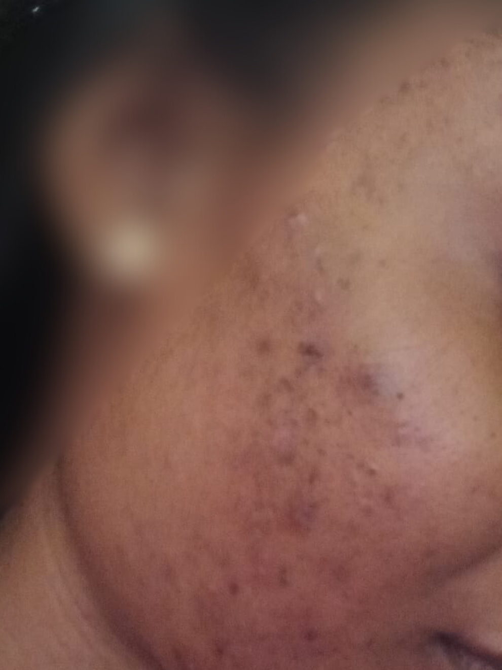 organic ingredients to help remove dark marks and spots on the face for black skin, uncle benney's products, oilblends natural skincare, soaps that heal