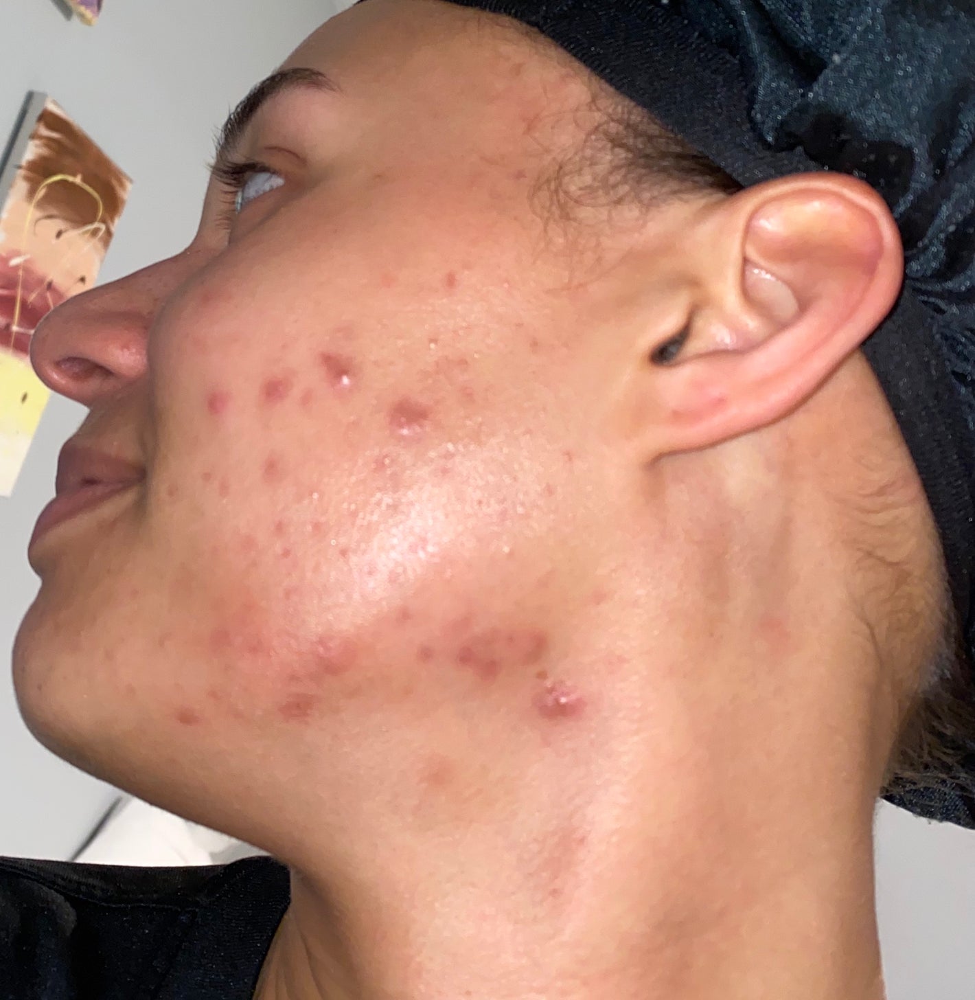 uncle benneys soaps that heal acne prone skin how to clear hyperpigmentation naturally